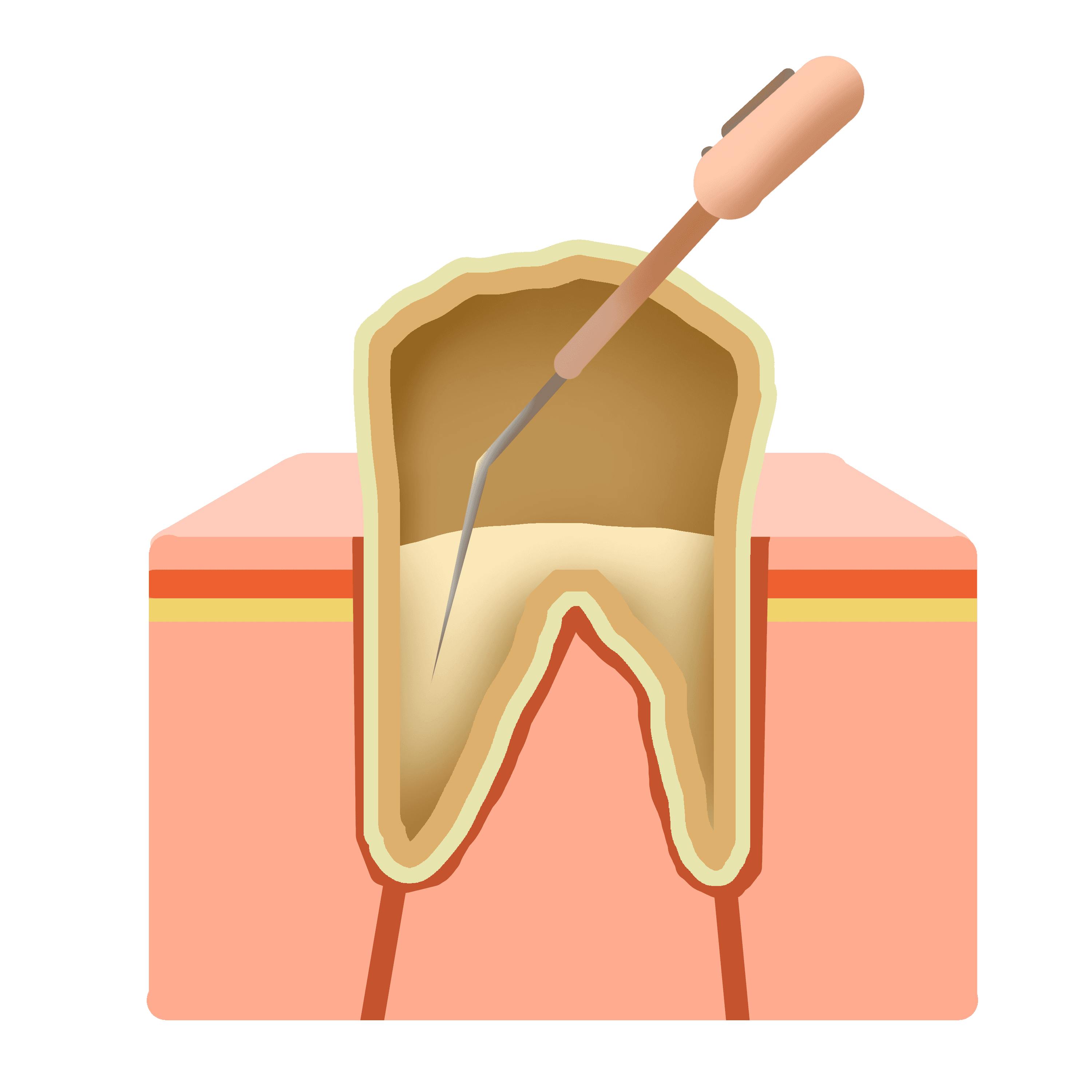 Why Choose Dr. Raman Kamboj for Root Canal Rct in West Delhi? - 52% Off