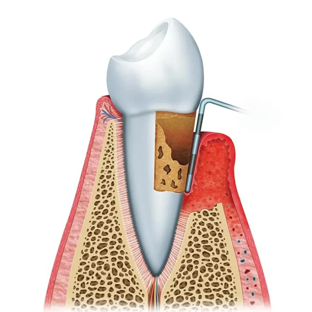 GDC Double End Probes Cp12 / Thin William #6 (Pcp12/Qow6) — Teethment catalog guide
