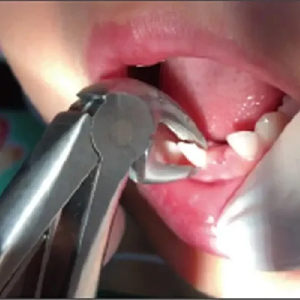 GDC Extraction Forceps Lower Pedo Premium (Fx1cp) — Teethment catalog guide