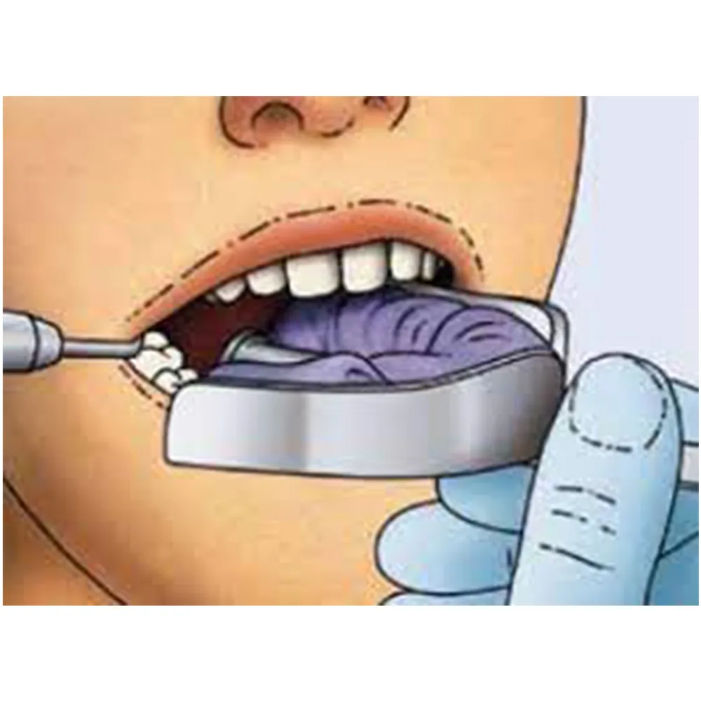 Gdc Impression Trays Dentulous Non Perforated — Teethment catalog guide